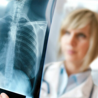 5 warning signs of lung cancer that should not be ignored