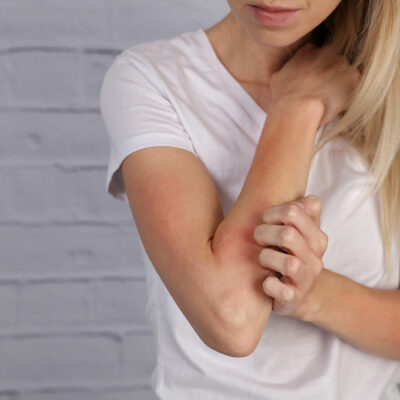 8 early signs of prurigo nodularis